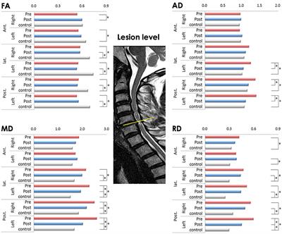 Spinal Cord Changes After Laminoplasty in Cervical Compressive Myelopathy: A Diffusion Tensor Imaging Study